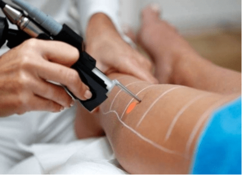 Kayseri Lazer Epilasyon