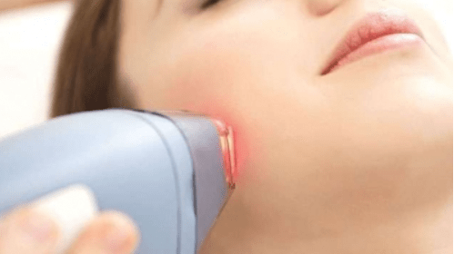 Kayseri Lazer Epilasyon